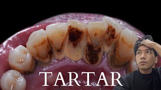 TARTAR [upl. by Kopaz]