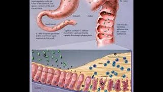 What You Need To Know About C Difficile Infection [upl. by Vano]