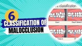 Classification of malocclusion  Orthodontics course [upl. by Garrard]