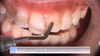 ESTELITE ASTERIA Clinical Guide EN  Tokuyama Dental [upl. by Holbrooke777]