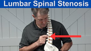 What is Lumbar Spinal Stenosis [upl. by Hanna]