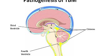 Pediatric DRTB Meningitis A CaseBased Discussion [upl. by Lilli820]