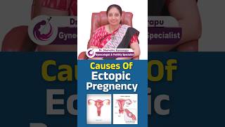 Causes of Ectopic Pregnancy Understanding the Risks and Prevention  shorts ectopicpregnancy [upl. by Ynafets]