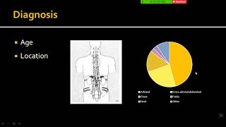 Imaging of Neuroblastoma [upl. by Babara409]