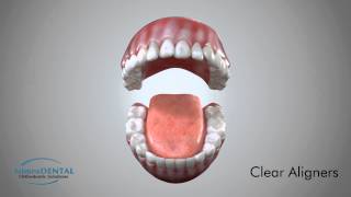 Clear Aligners  Orthodontic Appliance Demo [upl. by Garibold265]