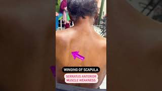 Winging of scapula [upl. by Deehahs]