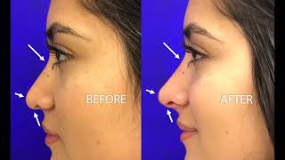 Liquid Rhinoplasty  Non Surgical Nose Job  Victor Lacombe MD  Santa Rosa [upl. by Cinomod]