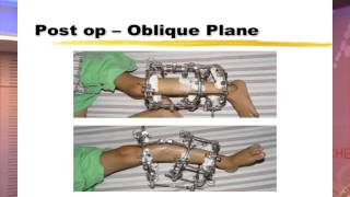 POSICON 2014 workshop on oblique plane deformity planning [upl. by Dallon]