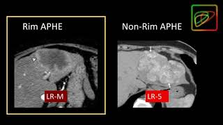 5 LIRADS Malignant lesions that are not definitely HCC LRM  Part 1 By Dr Kathryn Fowler [upl. by Roland]