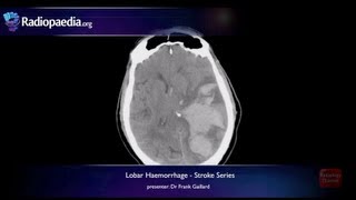 Stroke Lobar haemorrhage  radiology video tutorial MRI CT [upl. by Malvin]