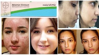 Advantan Ointment For FaceAcne Pigmentation amp Remove Black DarksDr Ijaz Malik [upl. by Nivk437]