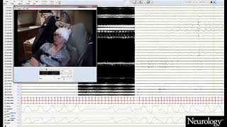 Limbic and paralimbic structures driving ictal central apnea Video 1 [upl. by Thormora]