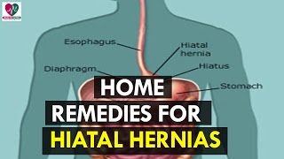 Home Remedies for Hiatal Hernias  Health Sutra [upl. by Eimmelc]