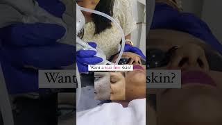 Acne Scar Treatment  Welona Clinic Chennai [upl. by Karlotta950]