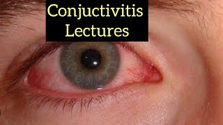 Conjuctivitis part 1 Eye lectures eye jatoi eyelectures conjuctivitis [upl. by Baxie466]