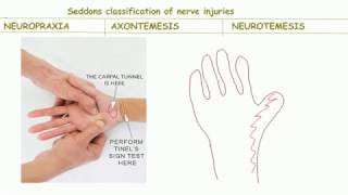 Seddons classification of nerve injurybackbenchers revolution [upl. by Yelhsa]