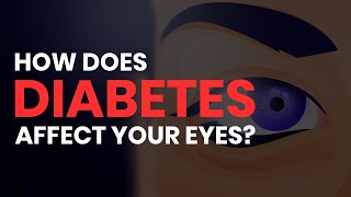 How Diabetes Affects Your Eyes Retinopathy Glaucoma Cataracts Macular Edema [upl. by Ken]