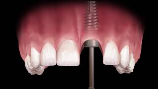 MultiPurpose Abutment to Fabricate a Custom Abutment [upl. by Attej]