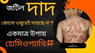 দাদের হোমিওপ্যাথিক চিকিৎসা  ringworm treatment in homeopathy medicine  Dr Manabendra Mondal [upl. by Primaveras967]