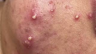 How to remove blackheads whiteheads on face Milia  Part 31 [upl. by Remliw412]