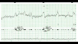 How to read a Cardiotocography CTG [upl. by Anirtak]