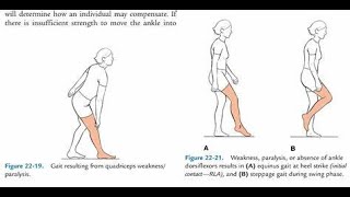 Steppage Gait Neuropathic Gait Slap Gait Foot Drop Gait  Causes Diagnosis Treatment [upl. by Hasheem]