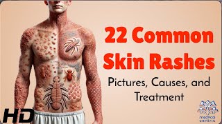 22 Skin Rashes Everyone Should Know About Symptoms amp Treatments [upl. by Lokcin586]