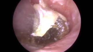 Hard and Impacted Ear Wax removed from Ear Canal and Eardrum  337 [upl. by Aynodal337]