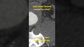 Lytic bone lesions caused by what doctor medicalstudent radiologyresident radiology radres [upl. by Puff]