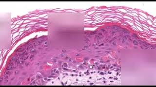 Erythema Multiforme Dermatopathology Easy learning [upl. by Tish]