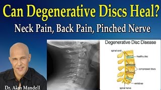 Can Degenerative Discs Heal Normal Again Neck Pain Back Pain Pinched Nerve  Dr Mandell [upl. by Anaud82]