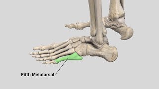 Metatarsal Fractures  Complete Anatomy [upl. by Windsor]