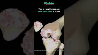 Understanding Knee Replacement Surgery StepbyStep Guide amp Recovery Tips  Medioks [upl. by Ycats]