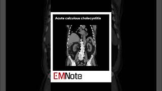 Acute Cholecystitis medical [upl. by Aek]