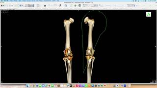 How to prepare a femur tomography with Osirix Dog with patellar Luxation [upl. by Stefa]