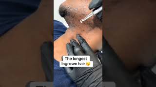 ingrown hair removal 😌 [upl. by Noied]