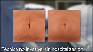 Radiofrecuencia Exilis Elite [upl. by Ymarej719]