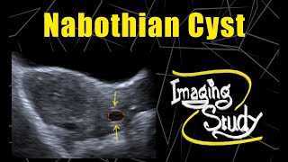 Nabothian Cyst  Ultrasound  Case 70 [upl. by Spencer]