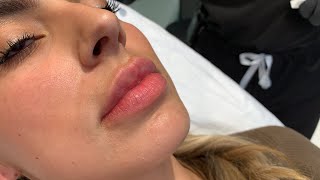 GET THOSE JUICY RUSSIAN LIPS 👄WITH NO DOWNTIME FILLER INJECTIONS  Hollywood CA  Dr Jason Emer [upl. by Eelaroc]