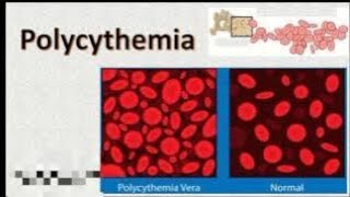 Polycythemia Definition of polycythemiaTypes of polycythemia💯💯 [upl. by Murdock]