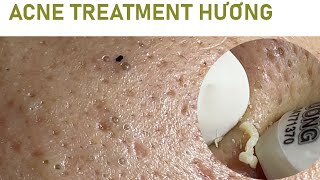 Acne Treatment Huong Da Nang  2024 blackheads 702 [upl. by Liagiba]