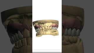 Flexible Denture Design [upl. by Datnow]