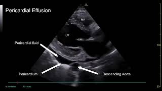 PoCUS Echo  Pericardial vs Pleural Effusions [upl. by Scrivens]