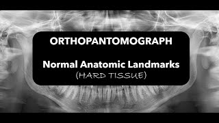 Hard tissue landmarks in OPG [upl. by Cicenia548]