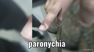 Paronychia  incision and drainage [upl. by Adnohsek]