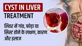 Cyst in Liver in Hindi Symptoms Treatment लिवर में गांठ फोड़ा या सिस्ट होने के लक्षण कारण और इलाज [upl. by Hock]