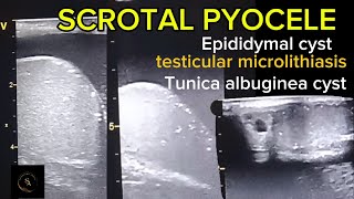 Complex hydroceleScrotal pyocele epididymal cyst testicular microlithiasis Tunica albuginea cyst [upl. by Teodoor594]