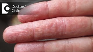 Difference between atopic dermatitis and eczema  Dr Rashmi Ravindra [upl. by Kieger]