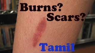 How to treat Burns and Scars  Tamil [upl. by Trilbie]