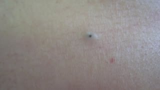 Dilated Pore Treatment [upl. by Onivag]